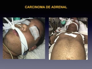 CARCINOMA DE ADRENAL
 