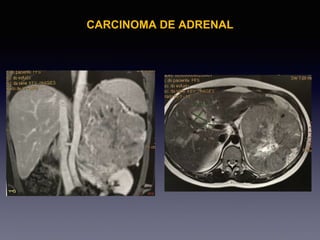 CARCINOMA DE ADRENAL
 