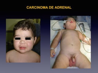CARCINOMA DE ADRENAL
 