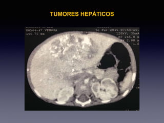 TUMORES HEPÁTICOS
 