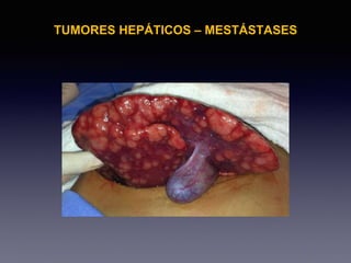 TUMORES HEPÁTICOS – MESTÁSTASES
 
