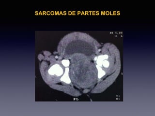 SARCOMAS DE PARTES MOLES
 