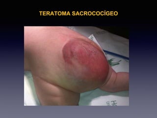 TERATOMA SACROCOCÍGEO
 