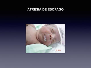 ATRESIA DE ESOFAGO
 
