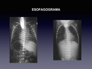 ESOFAGOGRAMA
 