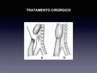 TRATAMENTO CIRÚRGICO
 