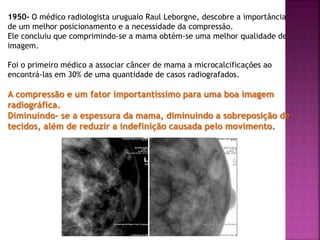1950- O médico radiologista uruguaio Raul Leborgne, descobre a importância
de um melhor posicionamento e a necessidade da compressão.
Ele concluiu que comprimindo-se a mama obtém-se uma melhor qualidade de
imagem.
Foi o primeiro médico a associar câncer de mama a microcalcificações ao
encontrá-las em 30% de uma quantidade de casos radiografados.
A compressão e um fator importantíssimo para uma boa imagem
radiográfica.
Diminuindo- se a espessura da mama, diminuindo a sobreposição de
tecidos, além de reduzir a indefinição causada pelo movimento.
 