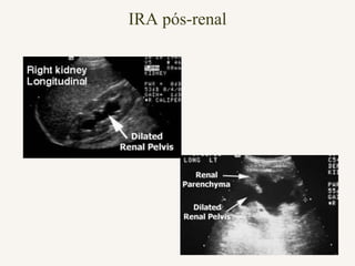 IRA pós-renal
 