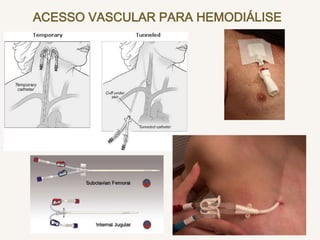 ACESSO VASCULAR PARA HEMODIÁLISE
 