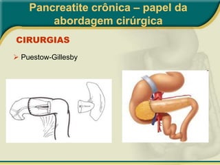  Insuficiência Pancreática (DM)