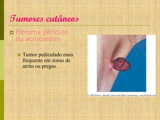 Tumores cutâneos


Fibroma pêndulo
ou acrocordon


Tumor pediculado mais
frequente em zonas de
atrito ou pregas.

 