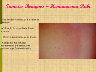 Tumores Benignos – Hemangioma Rubi
- São pápulas esféricas, de 1 a 5 mm de
diâmetro.
- Coloração de vermelho-brilhante
a escura.
- Ocorrem principalmente no tronco.
- Compostos por capilares
neo-formados e dilatados, sem
qualquer significação sistêmica.

 