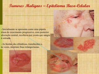 Tumores Malignos – Epitelioma Baso-Celular

- Inicialmente se apresenta como uma pápula
rósea de crescimento progressivo, com posterior
ulceração central, recoberta por crosta que sangra
à retirada.
- As bordas são cilíndricas, translúcidas e,
às vezes, mostram finas telangectasias.

 