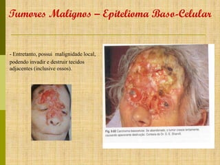 Tumores Malignos – Epitelioma Baso-Celular

- Entretanto, possui malignidade local,
podendo invadir e destruir tecidos
adjacentes (inclusive ossos).

 