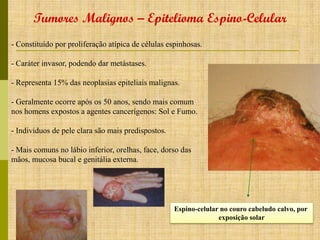 Tumores Malignos – Epitelioma Espino-Celular
- Constituído por proliferação atípica de células espinhosas.
- Caráter invasor, podendo dar metástases.
- Representa 15% das neoplasias epiteliais malignas.
- Geralmente ocorre após os 50 anos, sendo mais comum
nos homens expostos a agentes cancerígenos: Sol e Fumo.

- Indivíduos de pele clara são mais predispostos.
- Mais comuns no lábio inferior, orelhas, face, dorso das
mãos, mucosa bucal e genitália externa.

Espino-celular no couro cabeludo calvo, por
exposição solar

 