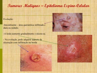 Tumores Malignos – Epitelioma Espino-Celular
Evolução:
-Inicialmente – área queratótica infiltrada e
dura ou nódulo.
-A lesão aumenta gradualmente e ulcera-se.

- Na evolução, pode adquirir aspecto de
ulceração com infiltração na borda

 