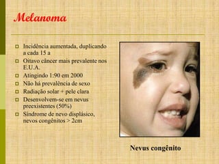 Melanoma








Incidência aumentada, duplicando
a cada 15 a
Oitavo câncer mais prevalente nos
E.U.A.
Atingindo 1:90 em 2000
Não há prevalência de sexo
Radiação solar + pele clara
Desenvolvem-se em nevus
preexistentes (50%)
Síndrome de nevo displásico,
nevos congênitos > 2cm

Nevus congênito

 