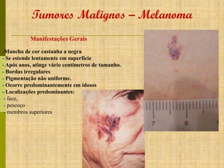 Tumores Malignos – Melanoma
Manifestações Gerais
-Mancha de cor castanha a negra
- Se estende lentamente em superfície
- Após anos, atinge vário centímetros de tamanho.
- Bordas irregulares
- Pigmentação não uniforme.
- Ocorre predominantemente em idosos
- Localizações predominantes:
- face,
- pescoço
- membros superiores

 