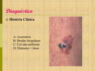 Diagnóstico


História Clínica

A: Assimetria
B: Bordas irregulares
C: Cor não uniforme
D: Diâmetro > 6mm

 