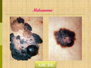Melanoma

ABCDE

 
