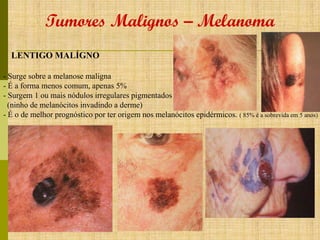 Tumores Malignos – Melanoma
LENTIGO MALÍGNO
- Surge sobre a melanose maligna
- É a forma menos comum, apenas 5%
- Surgem 1 ou mais nódulos irregulares pigmentados
(ninho de melanócitos invadindo a derme)
- É o de melhor prognóstico por ter origem nos melanócitos epidérmicos. ( 85% é a sobrevida em 5 anos)

 