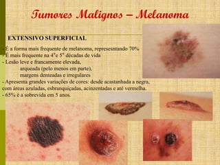 Tumores Malignos – Melanoma
EXTENSIVO SUPERFICIAL
- É a forma mais frequente de melanoma, represesntando 70%
- É mais frequente na 4°e 5° décadas de vida
- Lesão leve e francamente elevada,
arqueada (pelo menos em parte),
margens denteadas e irregulares
- Apresenta grandes variações de cores: desde acastanhada a negra,
com áreas azuladas, esbranquiçadas, acinzentadas e até vermelha.
- 65% é a sobrevida em 5 anos.

 