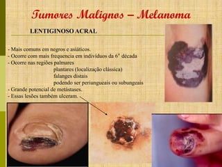 Tumores Malignos – Melanoma
LENTIGINOSO ACRAL
- Mais comuns em negros e asiáticos.
- Ocorre com mais frequencia em indivíduos da 6° década
- Ocorre nas regiões palmares
plantares (localização clássica)
falanges distais
podendo ser periungueais ou subungeais
- Grande potencial de metástases.
- Essas lesões também ulceram.

 