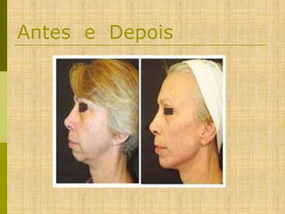 Antes e Depois

 