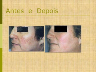 Antes e Depois

 