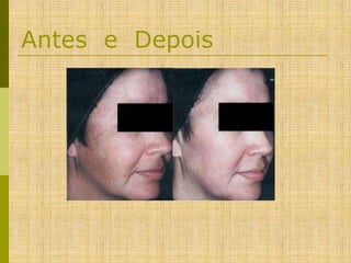 Antes e Depois

 