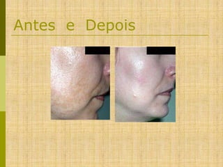 Antes e Depois

 