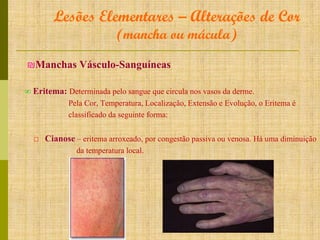 Lesões Elementares – Alterações de Cor
(mancha ou mácula)

₪Manchas Vásculo-Sanguíneas
∞ Eritema: Determinada pelo sangue que circula nos vasos da derme.
Pela Cor, Temperatura, Localização, Extensão e Evolução, o Eritema é
classificado da seguinte forma:

□ Cianose – eritema arroxeado, por congestão passiva ou venosa. Há uma diminuição
da temperatura local.

 