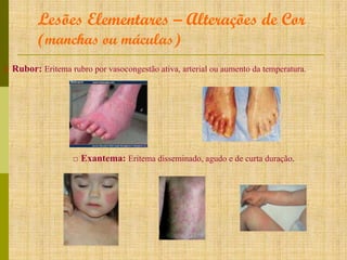 Lesões Elementares – Alterações de Cor
(manchas ou máculas)
□ Rubor: Eritema rubro por vasocongestão ativa, arterial ou aumento da temperatura.

□ Exantema: Eritema disseminado, agudo e de curta duração.

 