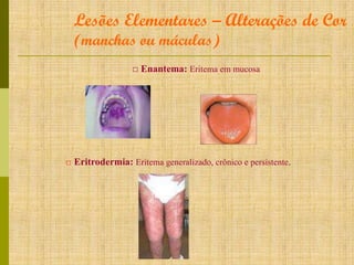 Lesões Elementares – Alterações de Cor
(manchas ou máculas)

□ Enantema: Eritema em mucosa

□ Eritrodermia: Eritema generalizado, crônico e persistente.

 