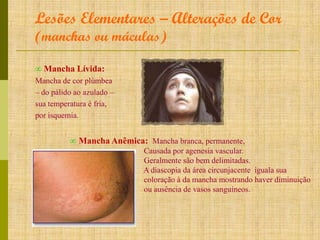 Lesões Elementares – Alterações de Cor
(manchas ou máculas)
∞ Mancha Lívida:
Mancha de cor plúmbea
– do pálido ao azulado –
sua temperatura é fria,
por isquemia.

∞ Mancha Anêmica: Mancha branca, permanente,
Causada por agenesia vascular.
Geralmente são bem delimitadas.
A diascopia da área circunjacente iguala sua
coloração à da mancha mostrando haver diminuição
ou ausência de vasos sanguíneos.

 