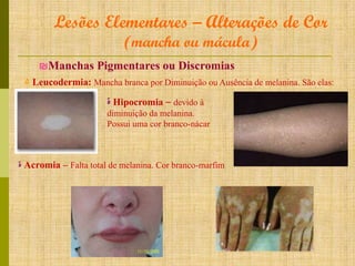 Lesões Elementares – Alterações de Cor
(mancha ou mácula)

₪Manchas Pigmentares ou Discromias
۵ Leucodermia: Mancha branca por Diminuição ou Ausência de melanina. São elas:
‫ ة‬Hipocromia – devido à
diminuição da melanina.
Possui uma cor branco-nácar

‫ ة‬Acromia – Falta total de melanina. Cor branco-marfim

 