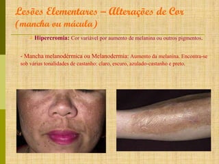 Lesões Elementares – Alterações de Cor
(mancha ou mácula)

۵ Hipercromia: Cor variável por aumento de melanina ou outros pigmentos.

- Mancha melanodérmica ou Melanodermia: Aumento da melanina. Encontra-se
sob várias tonalidades de castanho: claro, escuro, azulado-castanho e preto.

 