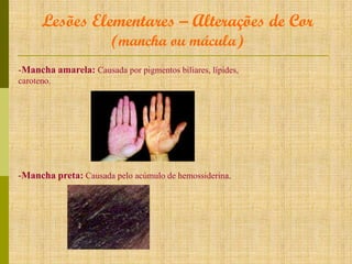 Lesões Elementares – Alterações de Cor
(mancha ou mácula)

-Mancha amarela: Causada por pigmentos biliares, lípides,
caroteno.

-Mancha preta: Causada pelo acúmulo de hemossiderina.

 