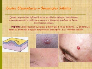 Lesões Elementares – Formações Sólidas
Quando os processos inflamatórios ou neoplásicos atingem, isoladamente
ou conjuntamente, a epiderme, a derme e a hipoderme resultam em Lesões
de formações Sólidas.

Ω Pápula: Lesão circunscrita, elevada e menor que 1 cm de diâmetro. A epiderme, a
derme ou ambas são atingidas por processos patológicos . Ex.: comedão fechado

 