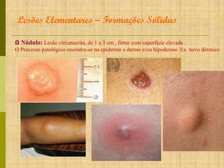 Lesões Elementares – Formações Sólidas
Ω Nódulo: Lesão circunscrita, de 1 a 3 cm , firme com superfície elevada .
O Processo patológico encontra-se na epiderme e derme e/ou hipoderme. Ex. nevo dérmico

 