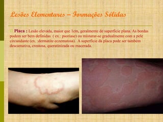 Lesões Elementares – Formações Sólidas
Ω Placa : Lesão elevada, maior que 1cm, geralmente de superfície plana. As bordas
podem ser bem definidas ( ex.: psoríase) ou misturar-se gradualmente com a pele
circundante (ex. :dermatite eczematosa). A superfície da placa pode ser também
descamativa, crostosa, queratinizada ou macerada.

 