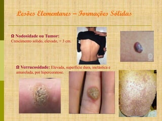 Lesões Elementares – Formações Sólidas
Ω Nodosidade ou Tumor:
Crescimento sólido, elevado, > 3 cm.

Ω Verrucosidade: Elevada, superfície dura, inelástica e
amarelada, por hiperceratose.

 
