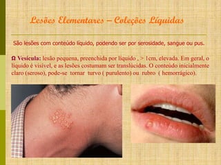 Lesões Elementares – Coleções Líquidas
São lesões com conteúdo líquido, podendo ser por serosidade, sangue ou pus.
Ω Vesícula: lesão pequena, preenchida por líquido , > 1cm, elevada. Em geral, o

líquido é visível, e as lesões costumam ser translúcidas. O conteúdo inicialmente
claro (seroso), pode-se tornar turvo ( purulento) ou rubro ( hemorrágico).

 
