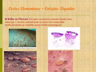 Lesões Elementares – Coleções Líquidas
Ω Bolha ou Flictena: Elevação circunscrita contendo líquido claro,
maior que 1 cm.Seu conteúdo pode-se tornar turvo-amarelado
(bolha purulenta) ou vermelho escuro (bolha hemorrágica)

 