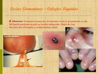 Lesões Elementares – Coleções Líquidas
Ω Abscesso: Formação circunscrita, de tamanho variável, proeminente ou não.
Há líquido purulento na pele ou tecidos subjacentes. Maior de 1cm.
Há calor, dor e flutuação e, eventualmente, rubor.

 