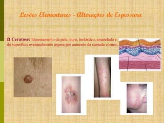Lesões Elementares - Alterações de Espessura

Ω Ceratose: Espessamento da pele, duro, inelástico, amarelado e
de superfície eventualmente áspera por aumento da camada córnea.

 