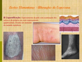 Lesões Elementares - Alterações de Espessura
Ω Liquenificação: Espessamento da pele com acentuação dos
sulcos e da própria cor, com espessamento
quadriculado. Ocorre um aumento
da camada espinhosa.

 