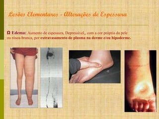 Lesões Elementares - Alterações de Espessura
Ω Edema: Aumento de espessura, Depressível,, com a cor própria da pele
ou rósea-branca, por extravasamento de plasma na derme e/ou hipoderme.

 