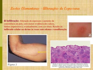 Lesões Elementares - Alterações de Espessura
Ω Infiltração: Alteração da espessura e aumento da
consistência da pele, com menor evidência dos sulcos,
limites imprecisos e, eventualmente, com cor rósea. Resulta de
infiltrado celular na derme às vezes com edema e vasodilatação.

 