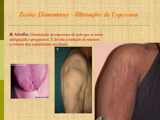 Lesões Elementares - Alterações de Espessura
Ω Atrofia: Diminuição da espessura de pele que se torna
adelgaçada e pregueavel. É devida à redução do número
e volume dos constituintes teciduais.

 